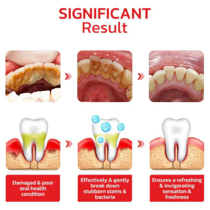 ✨SP-4 Probiotic Brightening & Stain Removing Toothpaste 🦷(2x100grams) BUY 1 GET 1 FREE